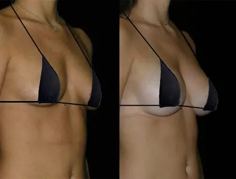 Before & After Photo