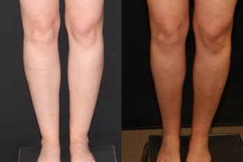 36 year old before and 6 months after cankle liposuction.