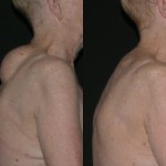 Before and After Lipoma Removal from Upper Back