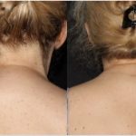 Before and After Lipoma Removal from Upper Back