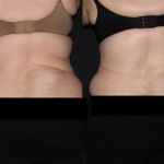 Before and after Lipoma Removal from Lower Back