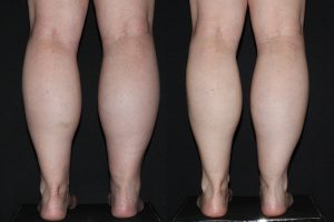 Calf reduction using Botox - before and six months after.
