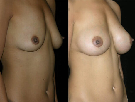 Breast Augmentation case #3488