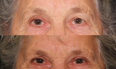 Blepharoplasty case #3440