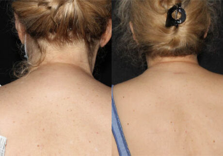 Minimal Scar Lipoma Removal case #3496