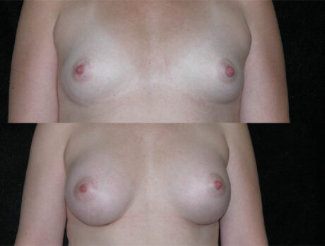 Breast Augmentation case #3486