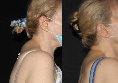 Minimal Scar Lipoma Removal case #3496