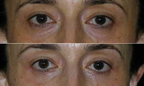 Blepharoplasty case #3442
