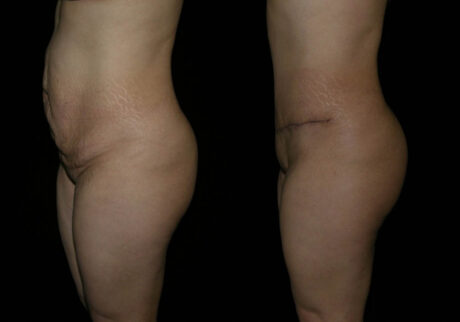 Tummy Tuck case #3534