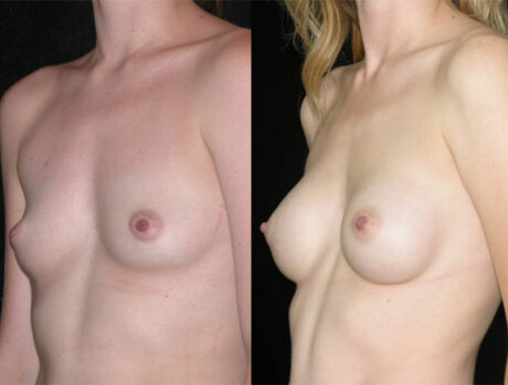 Breast Augmentation case #3484