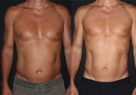 Minimal Scar Lipoma Removal case #3503