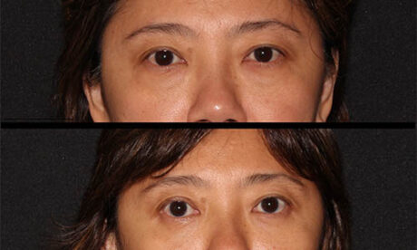 Blepharoplasty case #3446
