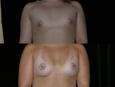 Breast Augmentation case #3480