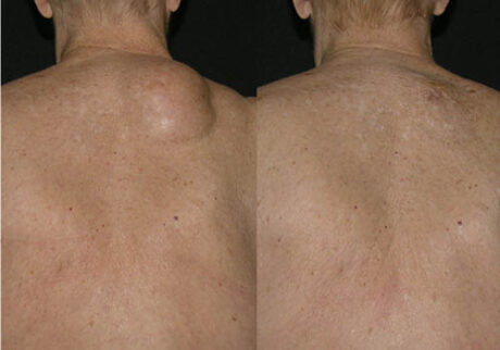 Minimal Scar Lipoma Removal case #3513
