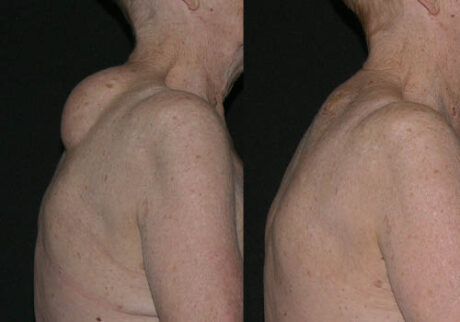 Minimal Scar Lipoma Removal case #3518