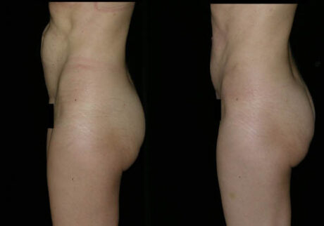 Minimal Scar Lipoma Removal case #3520