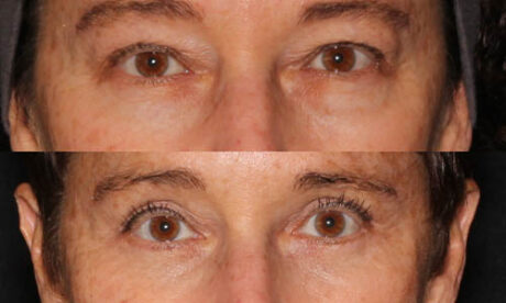 Blepharoplasty case #3464