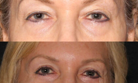 Blepharoplasty case #3466