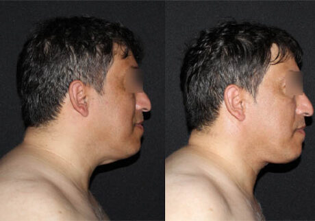 Minimal Scar Lipoma Removal case #3523