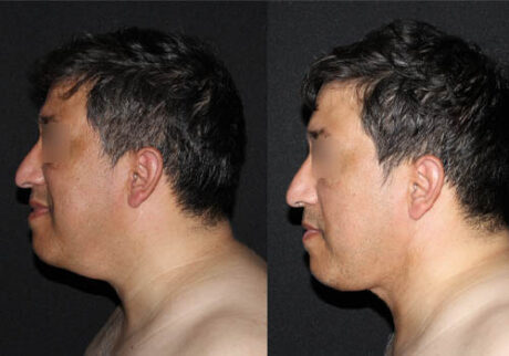 Minimal Scar Lipoma Removal case #3523