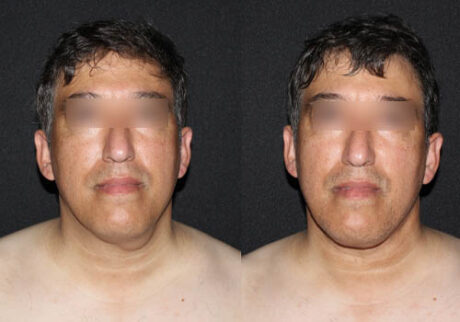 Minimal Scar Lipoma Removal case #3523