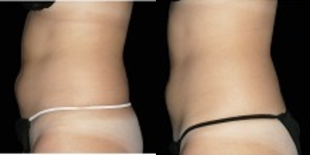 Emsculpt case #37960