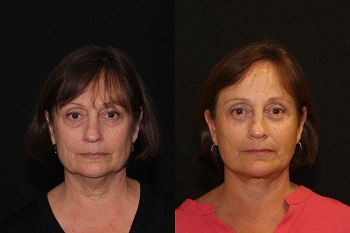 Facelift case #37558