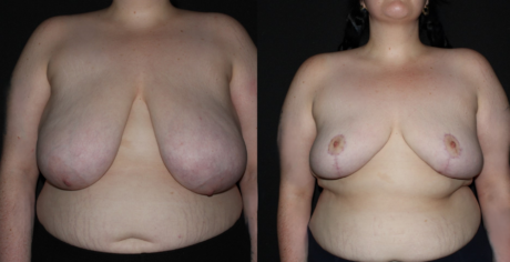 Breast Reduction case #37714