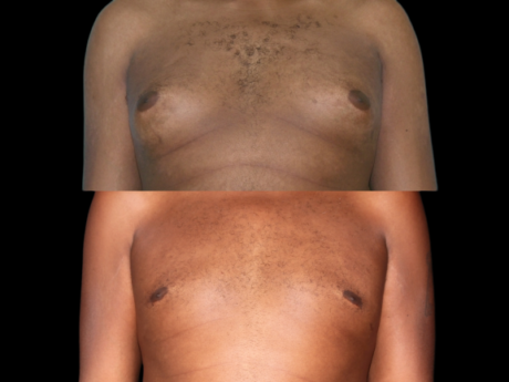 Gynecomastia (Male Breast Reduction) case #37783