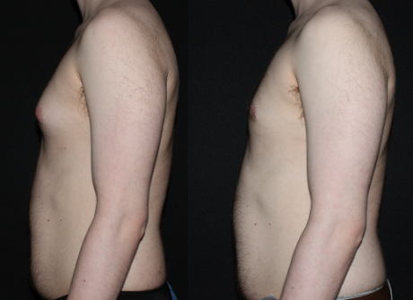 Gynecomastia (Male Breast Reduction) case #37770