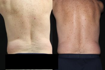 Coolsculpting case #37937