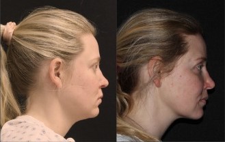 Kybella case #37632