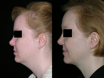Neck Lift & Chin Augmentation case #37631