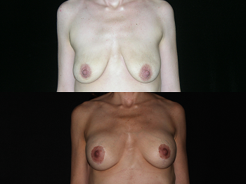 Breast Lift case #37759