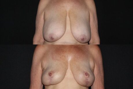 Breast Reduction case #37696