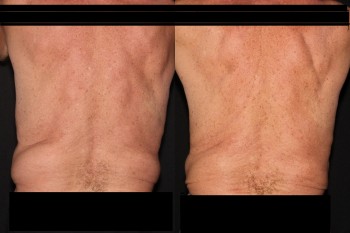 Coolsculpting case #37947