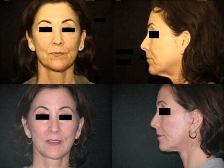 Facelift case #37554