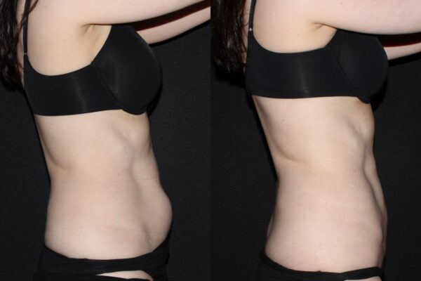 42-year-old before and after abdominal liposuction side view