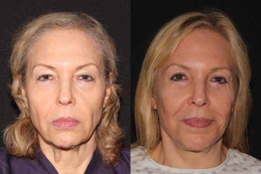 Z-Rhytidectomy-19970424081006515-20200214104032490-e1582899666590