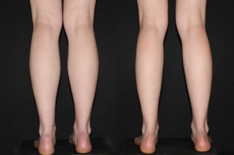 Cankles: Calf and Ankle Liposuction case #43221