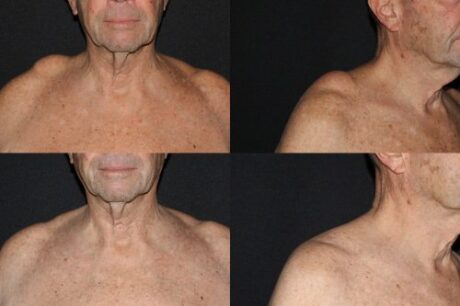 Minimal Scar Lipoma Removal case #37925