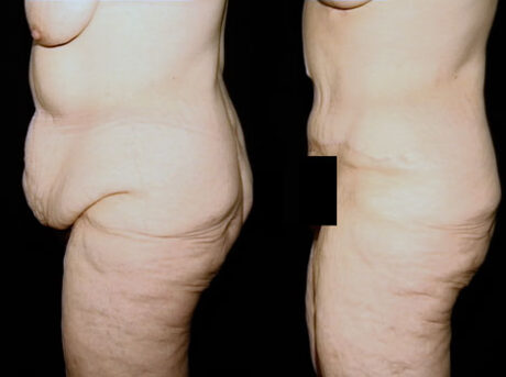 Tummy Tuck case #37786