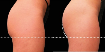 Emsculpt case #37962