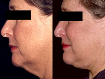 Facelift case #37561