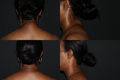 Minimal Scar Lipoma Removal case #37921
