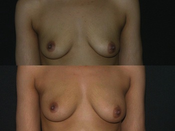 Breast Augmentation case #37669