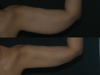 Arm Lift case #37798