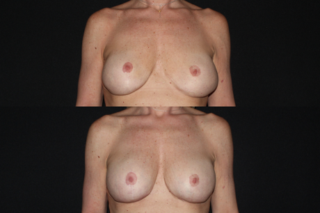 Breast Lift case #37753