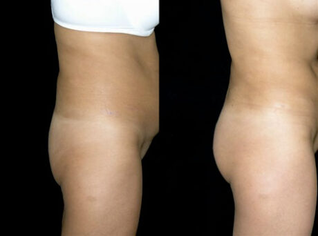 Butt Augmentation case #37803