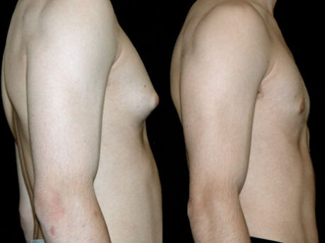 Gynecomastia (Male Breast Reduction) case #37780